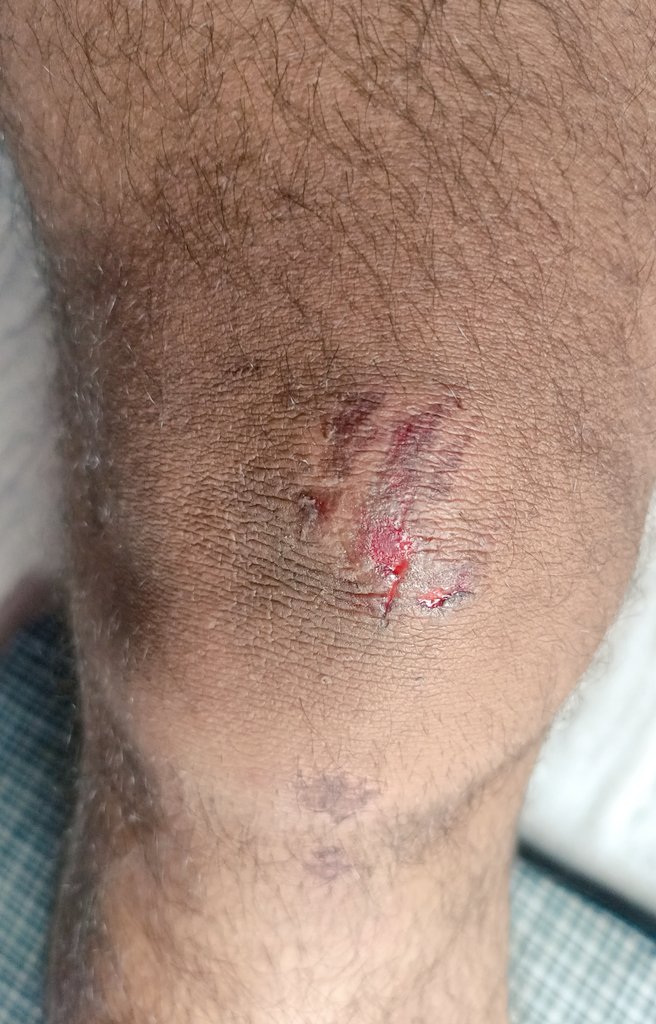 PrasantPathak_'s tweet image. आज जिम जाने के क्रम में बाइक से माइनर एक्सिडेंट हो गया मगर मेरा जज्बा देखिए, उठा घर आया, पेन किलर खाया , जिम चला गया 

Thats called #Gymaddict