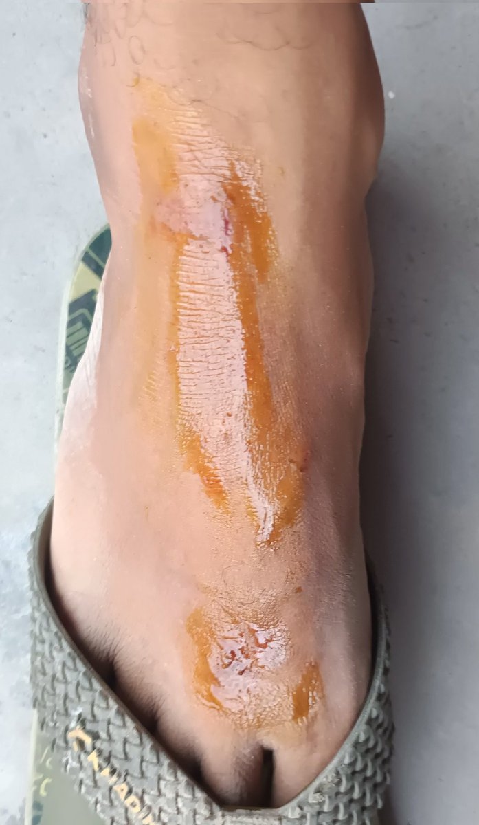 PrasantPathak_'s tweet image. आज जिम जाने के क्रम में बाइक से माइनर एक्सिडेंट हो गया मगर मेरा जज्बा देखिए, उठा घर आया, पेन किलर खाया , जिम चला गया 

Thats called #Gymaddict