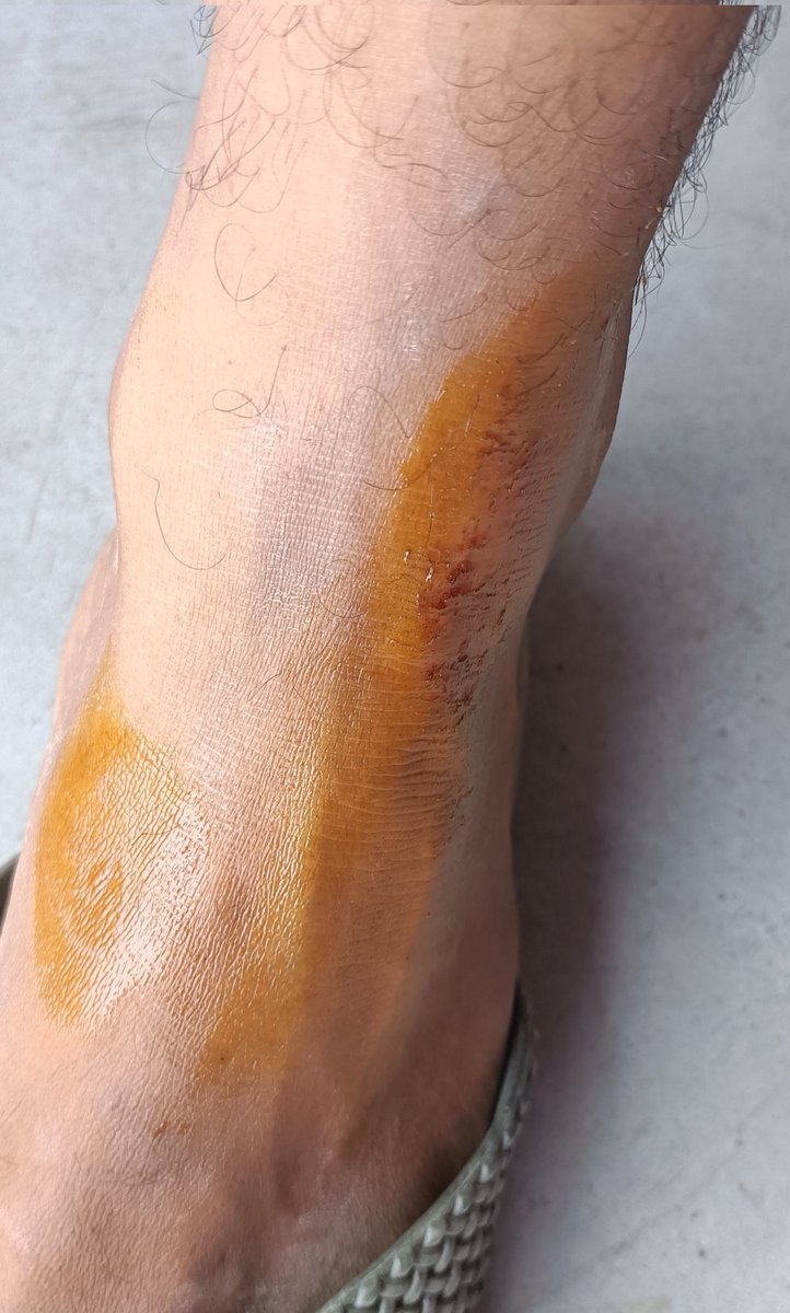 PrasantPathak_'s tweet image. आज जिम जाने के क्रम में बाइक से माइनर एक्सिडेंट हो गया मगर मेरा जज्बा देखिए, उठा घर आया, पेन किलर खाया , जिम चला गया 

Thats called #Gymaddict