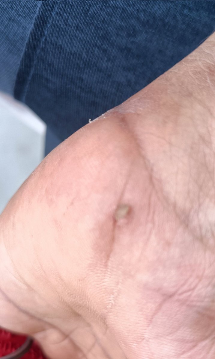 PrasantPathak_'s tweet image. आज जिम जाने के क्रम में बाइक से माइनर एक्सिडेंट हो गया मगर मेरा जज्बा देखिए, उठा घर आया, पेन किलर खाया , जिम चला गया 

Thats called #Gymaddict