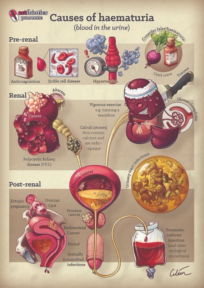 Journal of Brown Hospital Medicine (@brownjhm) on Twitter photo Causes of hematuria <a href="/artibiotics/">Ciléin Kearns</a> #MedEd Causes of hematuria <a href="/artibiotics/">Ciléin Kearns</a> #MedEd
