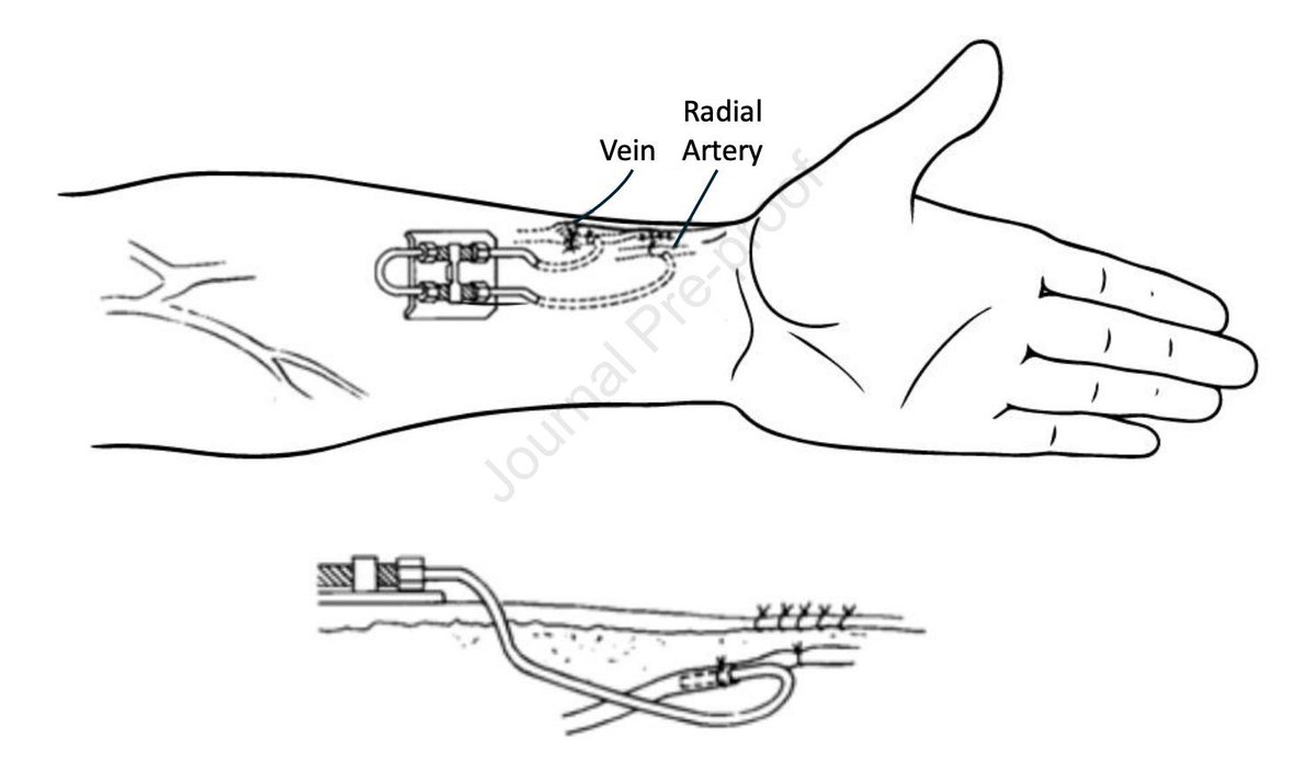 Hemodialysis Vascular Access: A Historical Perspective on Access Promotion, Barriers, and Lessons for the Future 

buff.ly/3A2KXAt
