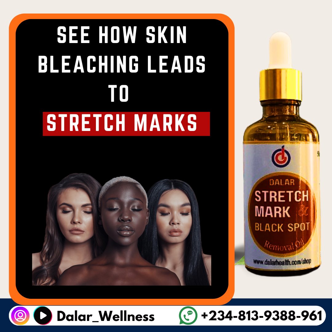 dalarskincare's tweet photo. Did you know that skin bleaching can lead to stretch marks? Here's why👇
#stretchmarks https://t.co/nVUFMtQCIr