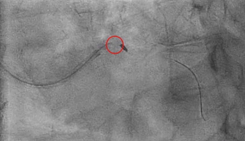 Salvatore Brugaletta (@sbrugaletta) on Twitter photo Check out part II of this case. you decided the strategy, and not you have to deal with such complication. how to solve it? <a href="/gabor_gt/">Gabor G Toth</a> <a href="/anassmaaroufi2/">Anass Maaroufi</a> <a href="/PCRonline/">PCRonline 🫀</a> <a href="/EAPCIPresident/">EAPCIPresident</a> <a href="/escardio/">European Society of Cardiology</a> <a href="/deharo_pierre/">pierredeharo</a> <a href="/shci_sec/">ACI-SEC: Hemodinamica</a> pcronline.com/Cases-resource… Check out part II of this case. you decided the strategy, and not you have to deal with such complication. how to solve it? <a href="/gabor_gt/">Gabor G Toth</a> <a href="/anassmaaroufi2/">Anass Maaroufi</a> <a href="/PCRonline/">PCRonline 🫀</a> <a href="/EAPCIPresident/">EAPCIPresident</a> <a href="/escardio/">European Society of Cardiology</a> <a href="/deharo_pierre/">pierredeharo</a> <a href="/shci_sec/">ACI-SEC: Hemodinamica</a> pcronline.com/Cases-resource…