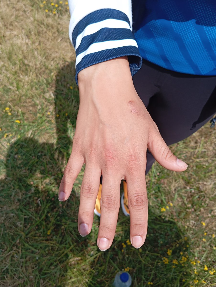 jon_selvaraj's tweet photo. Six hours of training with a 1.4kg pistol every day for 6 years will leave a mark. "It's something that will never go away," says Manu Bhaker of the bruising on her shooting hand. Neither will the two Olympic bronze medals either. @sportstarweb https://t.co/8Bvq9vsWfT