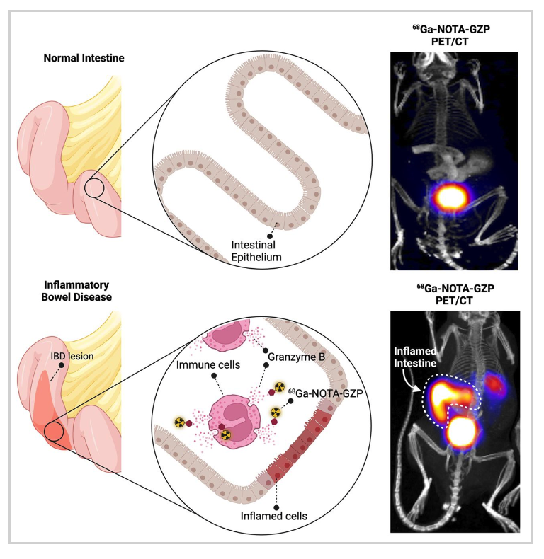 Applied_Rad's tweet photo. Novel PET Imaging Tool Detects Inflammatory Bowel Disease and Predicts Treatment Response
π https://t.co/pAkcBRSwz9
βA non-invasive imaging method to detect immune system activation with high resolution is key to improving IBD management.β
#RadNews #GIimaging #PETCT https://t.co/3NSGgYFNre