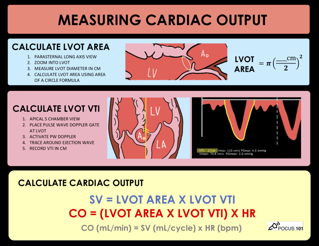 Shoaib9702's tweet photo. #EchoX
SV on Echo
Step 1..Calculate LVOT Area
•Take PLAX View
•Measure LVOT diameter
•Calculate LVOT Area .(0.785×D square)
Step 2.. Calculate LVOT VTI
•Take Apical 5C view
•Place PW cursor at LVOT
•Trace LVOT VTI
Step 3 . Calculate SV
SV=LVOT area ×LVOT VTI https://t.co/VjmXhBP1wq