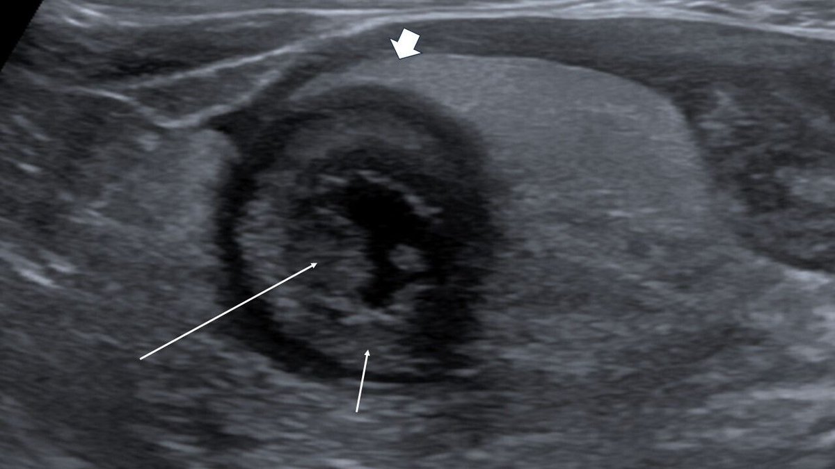 Frontline Gastro (@frontgastro_bmj) on Twitter photo Intestinal USS really kicking up force! Read this excellent paper on how this can be implemented in the clinic setting:
bit.ly/4ccQB06
<a href="/PhilSmithIsBack/">Phil Smith</a> <a href="/sheiybani/">Gio McGinty</a> <a href="/MohsenSubhani/">Mohsen Subhani</a> <a href="/VivekGoodoory/">Vivek Goodoory</a> <a href="/RexWHHui/">Rex Wan-Hin Hui</a> <a href="/DunnePdj/">Philip Dunne</a> <a href="/DrJMKennedy/">James Kennedy</a> <a href="/BSGTrainees/">BSG Trainees</a> Intestinal USS really kicking up force! Read this excellent paper on how this can be implemented in the clinic setting:
bit.ly/4ccQB06
<a href="/PhilSmithIsBack/">Phil Smith</a> <a href="/sheiybani/">Gio McGinty</a> <a href="/MohsenSubhani/">Mohsen Subhani</a> <a href="/VivekGoodoory/">Vivek Goodoory</a> <a href="/RexWHHui/">Rex Wan-Hin Hui</a> <a href="/DunnePdj/">Philip Dunne</a> <a href="/DrJMKennedy/">James Kennedy</a> <a href="/BSGTrainees/">BSG Trainees</a>
