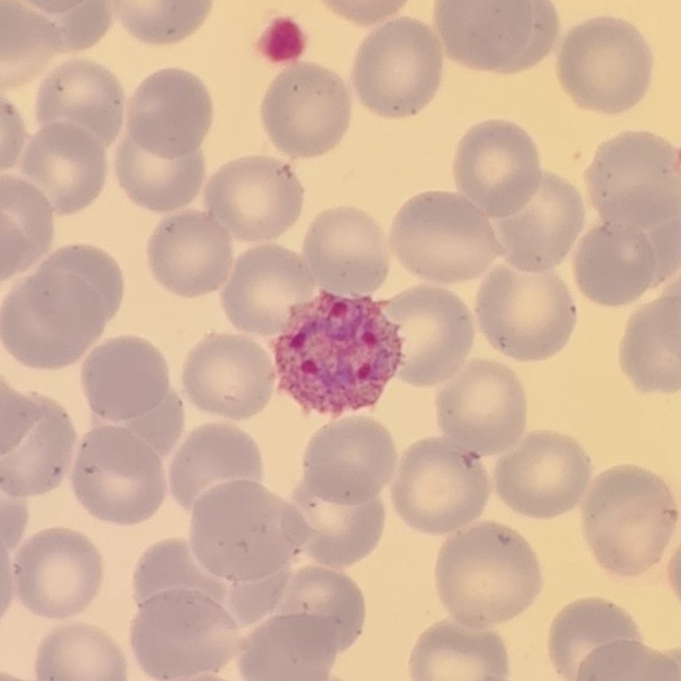 BloodScientist's tweet photo. "It looks like a cupcake," said @femtobrewster in the message alongside this image. I see it, do you?

Who doesn't love cupcakes 🧁?

#OnlyCells #RedCells #Parasite #Saturday #malaria #weekend
_____
📸: Photograph shared by @femtobrewster https://t.co/AzBOjaa8mY