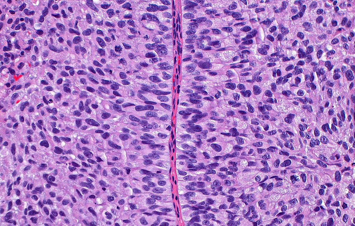 "Road across the urothelial carcinoma landscape" ~ #GUpath #PathArt