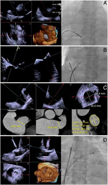 Xavier Millán (@icsmillan) on Twitter photo Four-dimensional intracardiac echocardiography-guided appendage occlusion
📣Recently published!
Watch the video online🧐
🔗sciencedirect.com/science/articl…
<a href="/RevEspCardiol/">REC Publications</a> <a href="/StructuralBCN/">Dabit Arzamendi</a> <a href="/ChelhJamhour/">Karim Jamhour Chelh</a> <a href="/HospitalSantPau/">Sant Pau - Campus Salut Barcelona</a> Four-dimensional intracardiac echocardiography-guided appendage occlusion
📣Recently published!
Watch the video online🧐
🔗sciencedirect.com/science/articl…
<a href="/RevEspCardiol/">REC Publications</a> <a href="/StructuralBCN/">Dabit Arzamendi</a> <a href="/ChelhJamhour/">Karim Jamhour Chelh</a> <a href="/HospitalSantPau/">Sant Pau - Campus Salut Barcelona</a>