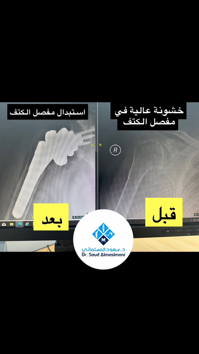 Saud_Almaslmani's tweet photo. واحد من أهم اهداف عمليات استبدال 
المفاصل هو تحسين جودة الحياة. 

مرفق فيديو لمريض كان لا يستطيع تحريك الكتف بسبب خشونه عالية اثرت على نشاطاته اليومية حتى البسيطة منها مثل ال��كل! ،، ولله الحمد الان يستطيع تحريك الكتف في جميع الاتجاهات https://t.co/0EHR4iVcrc
