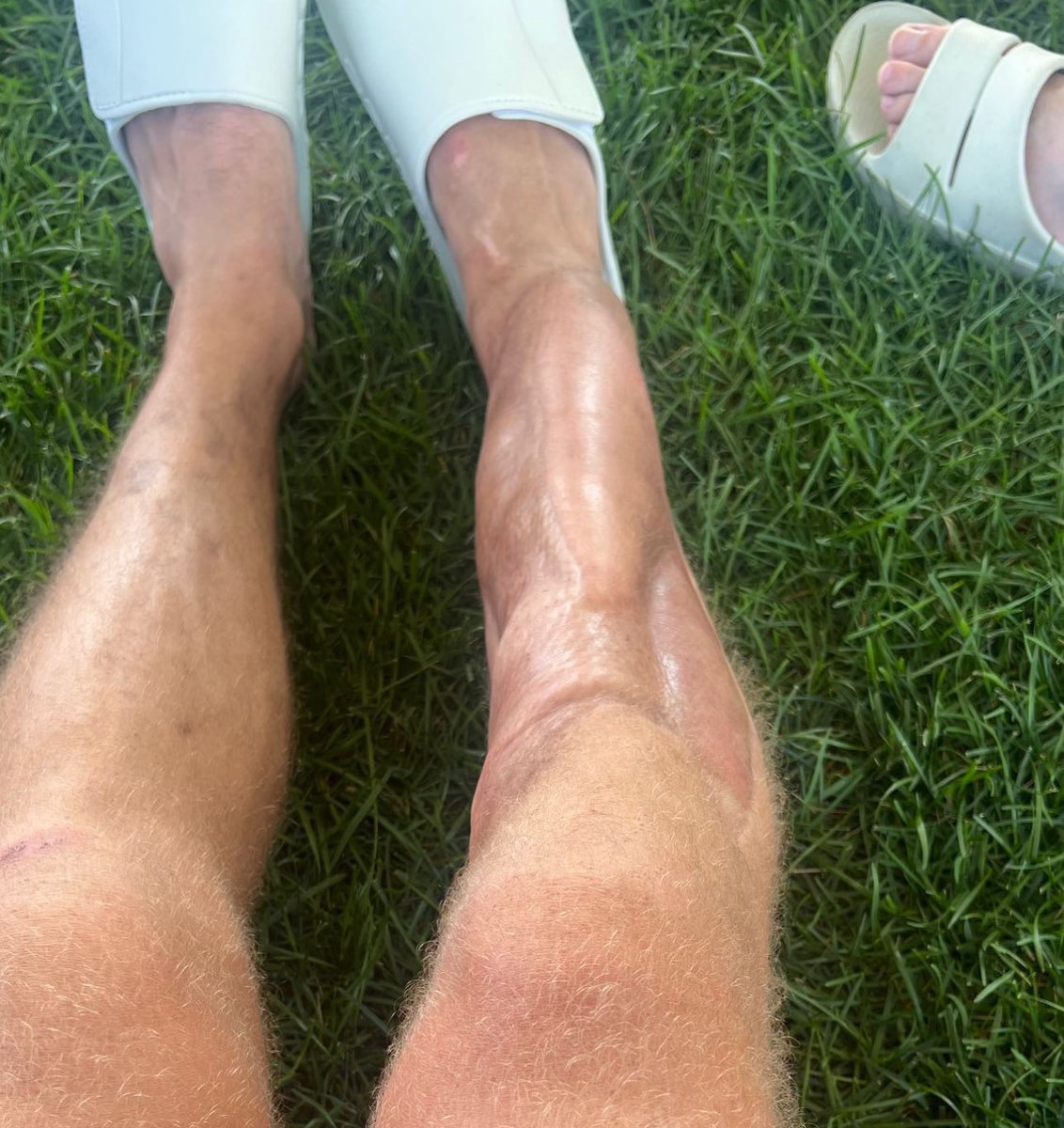 NFL_DovKleiman's tweet photo. Alex Smith’s leg 6 years after he shattered his tibia and fibula. https://t.co/khtpNkZzJC