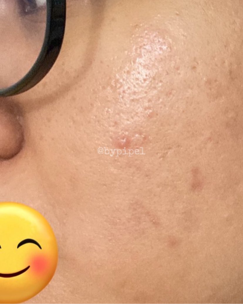 bypipel's tweet photo. Laser CO2 Fractional
First of all, skin type aku oily acne prone / kadang combi tergantung cuaca. Yang dry skin bisa ikut baca juga, bisa jadi permasalahan kulitnya sama👍🏻✨

Aku mau kasih liat foto kulit aku sebelum treatment laser ya👇🏻👇🏻 https://t.co/L5qPPH5ohz