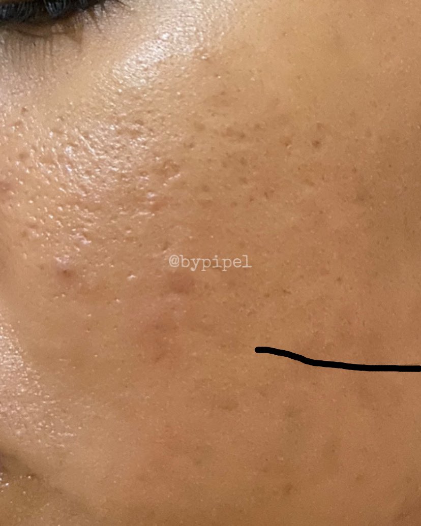 bypipel's tweet photo. Laser CO2 Fractional
First of all, skin type aku oily acne prone / kadang combi tergantung cuaca. Yang dry skin bisa ikut baca juga, bisa jadi permasalahan kulitnya sama👍🏻✨

Aku mau kasih liat foto kulit aku sebelum treatment laser ya👇🏻👇🏻 https://t.co/L5qPPH5ohz