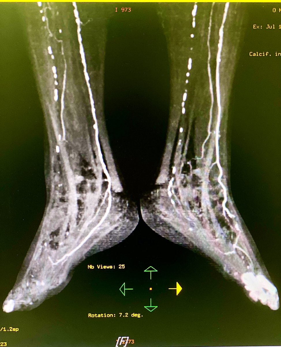 markzroland's tweet photo. One thing I learned during my fellowship is that not all lesions should be intervened, even if we are capable.
Consider the patient's condition/indication, team, equipment and insurance coverage.
#interventionalcardiology #peripheralintervention https://t.co/hCrMoKeojv