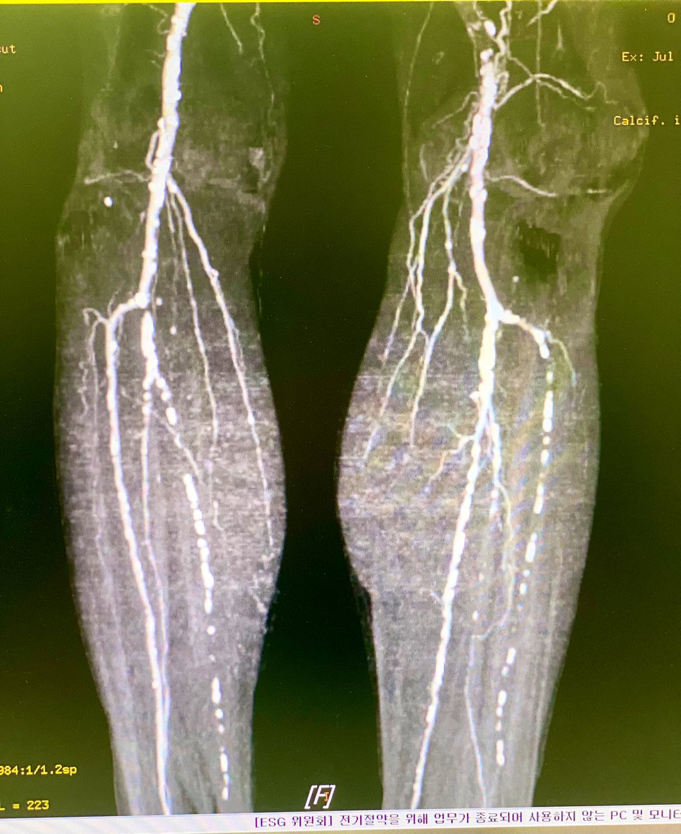 markzroland's tweet photo. One thing I learned during my fellowship is that not all lesions should be intervened, even if we are capable.
Consider the patient's condition/indication, team, equipment and insurance coverage.
#interventionalcardiology #peripheralintervention https://t.co/hCrMoKeojv