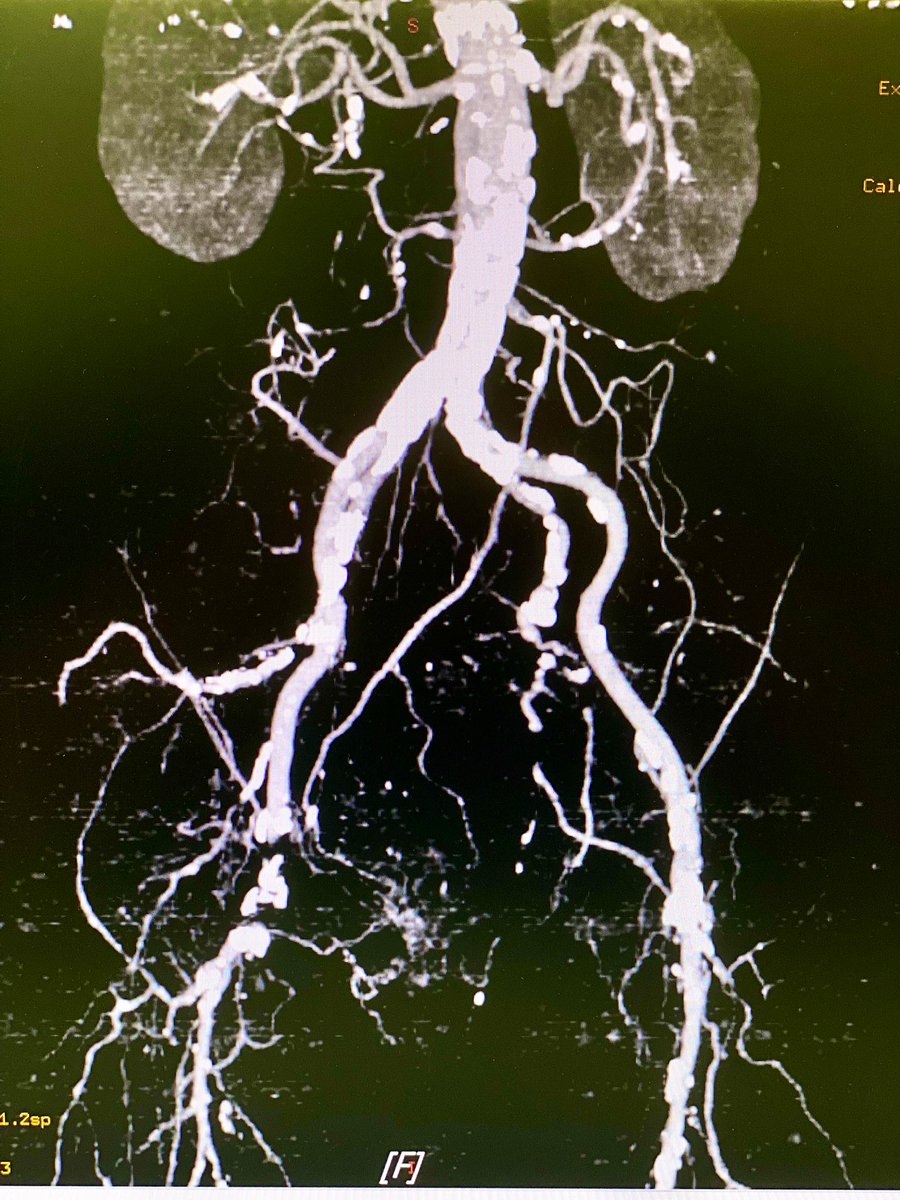 markzroland's tweet photo. One thing I learned during my fellowship is that not all lesions should be intervened, even if we are capable.
Consider the patient's condition/indication, team, equipment and insurance coverage.
#interventionalcardiology #peripheralintervention https://t.co/hCrMoKeojv