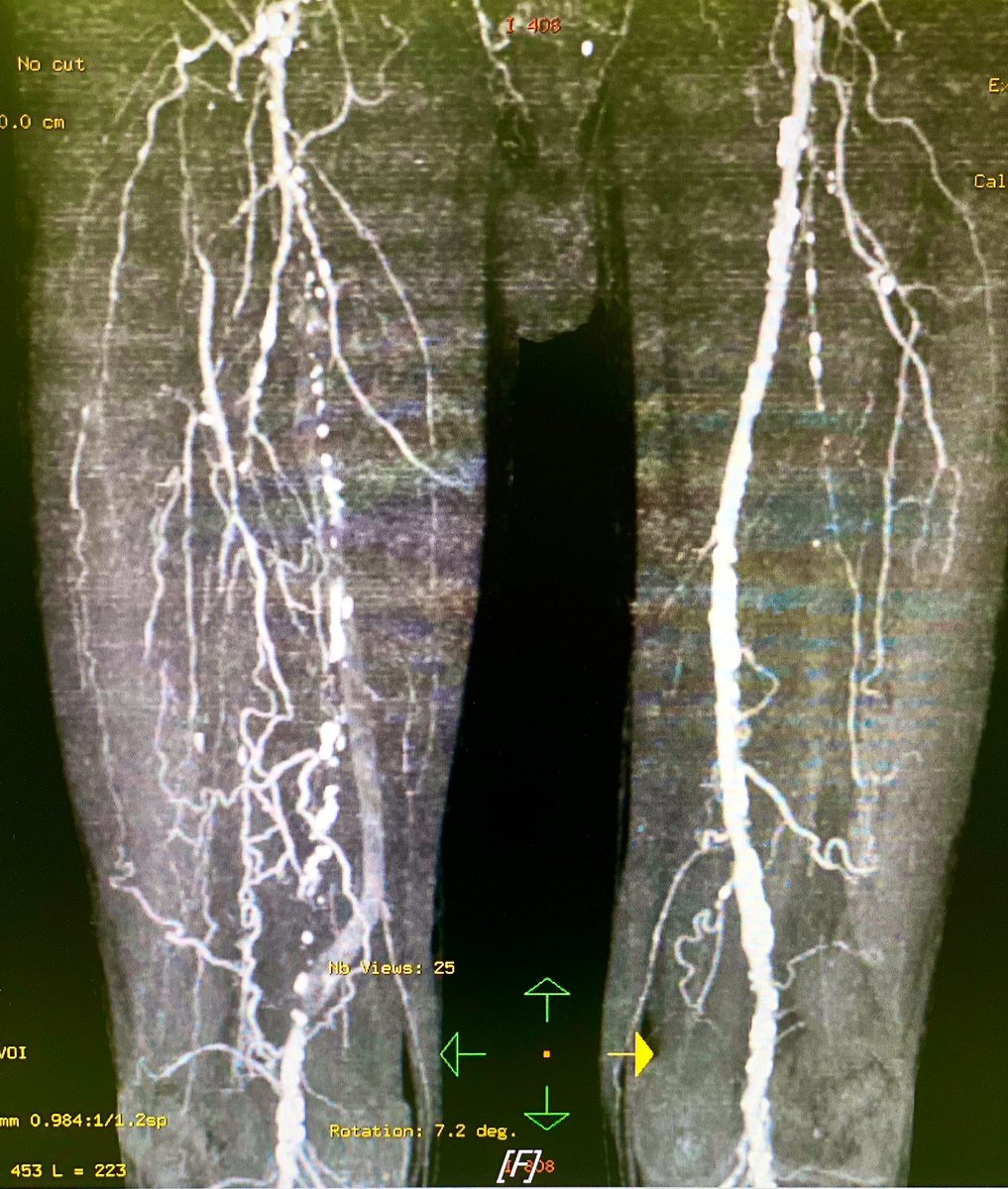 markzroland's tweet photo. One thing I learned during my fellowship is that not all lesions should be intervened, even if we are capable.
Consider the patient's condition/indication, team, equipment and insurance coverage.
#interventionalcardiology #peripheralintervention https://t.co/hCrMoKeojv