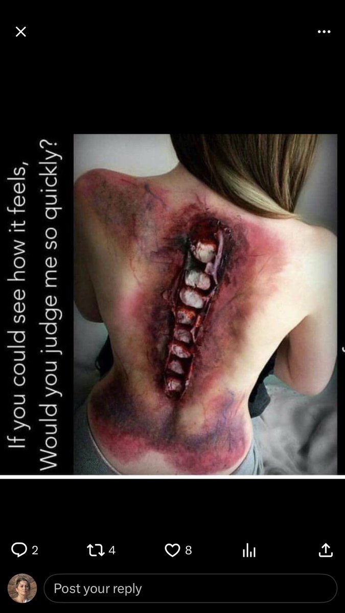 What it feels like every day to live with #chronicpain … But pain, I have learned to accept, but I want to still be able to take a walk on my own 2 feet and I’m looking to the future-still no sign of anybody coming to help stop preventable damage happening to so many … #fight