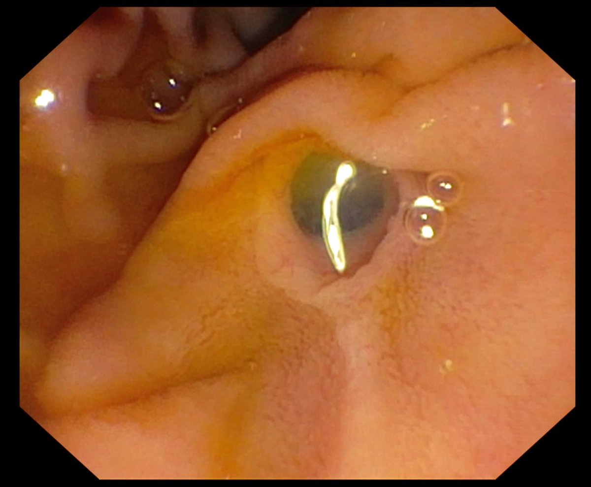 🚨 Investigating the association between the morphology of the papilla and the use of advanced cannulation techniques in #endoscopic retrograde cholangiopancreatography (#ERCP)

🔴 Please fill in this survey🙏
👉redcap.link/zagx4jz5

<a href="/ESGE_news/">ESGE</a> <a href="/my_ueg/">my_UEG</a> 
#GITwitter
#endoscopy🔵