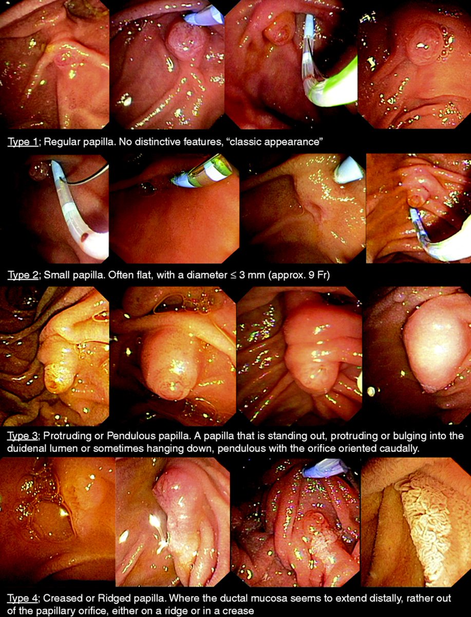 Lumír Kunovský (@lumirkunovsky) on Twitter photo 🔴 #Endoscopic #classification of the papilla of Vater
➡️ Check out this article before taking the survey❗️
📕 only in <a href="/UEGJournal/">UEGJ</a> 🙃
👉tinyurl.com/yx5229ke
<a href="/EndoscopyNow/">EndoscopyNow</a> <a href="/xerobal/">Balint Eross</a>
<a href="/YouppiePancreas/">YOUPPIE Pancreas</a>
#MedEd #MedTwitter
#myUEGcommunity
#GITwitter #endoscopy #ERCP 🔴 🔴 #Endoscopic #classification of the papilla of Vater
➡️ Check out this article before taking the survey❗️
📕 only in <a href="/UEGJournal/">UEGJ</a> 🙃
👉tinyurl.com/yx5229ke
<a href="/EndoscopyNow/">EndoscopyNow</a> <a href="/xerobal/">Balint Eross</a>
<a href="/YouppiePancreas/">YOUPPIE Pancreas</a>
#MedEd #MedTwitter
#myUEGcommunity
#GITwitter #endoscopy #ERCP 🔴