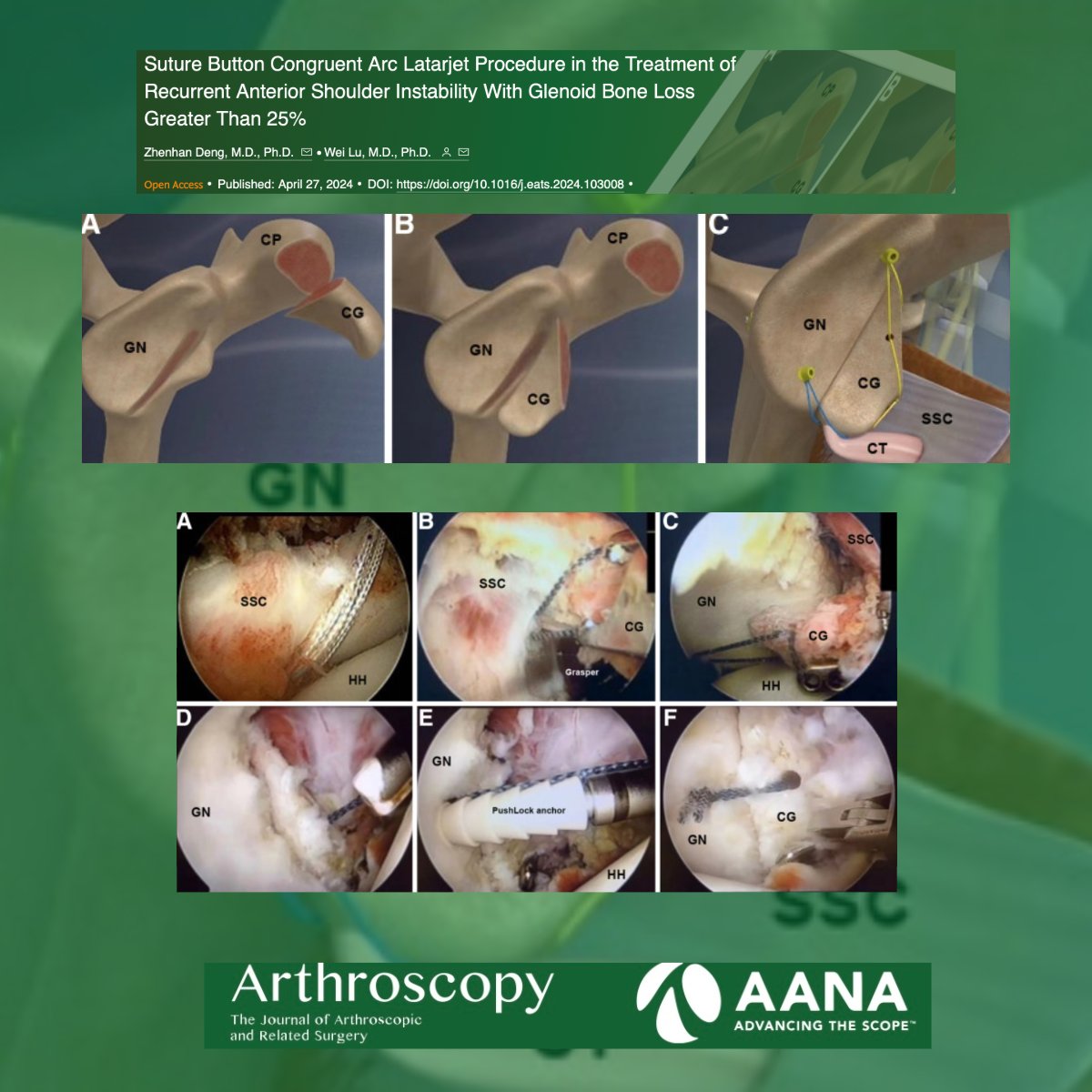ArthroscopyJ's tweet image. Suture Button Congruent Arc Latarjet Procedure in the Treatment of Recurrent Anterior Shoulder Instability With Glenoid Bone Loss Greater Than 25% #CongruentArc #LatarjetProcedure #ShoulderInstability #GlenoidBoneLoss #OrthopedicSurgery #SportsMedicine

ow.ly/oKNN50SLpWK