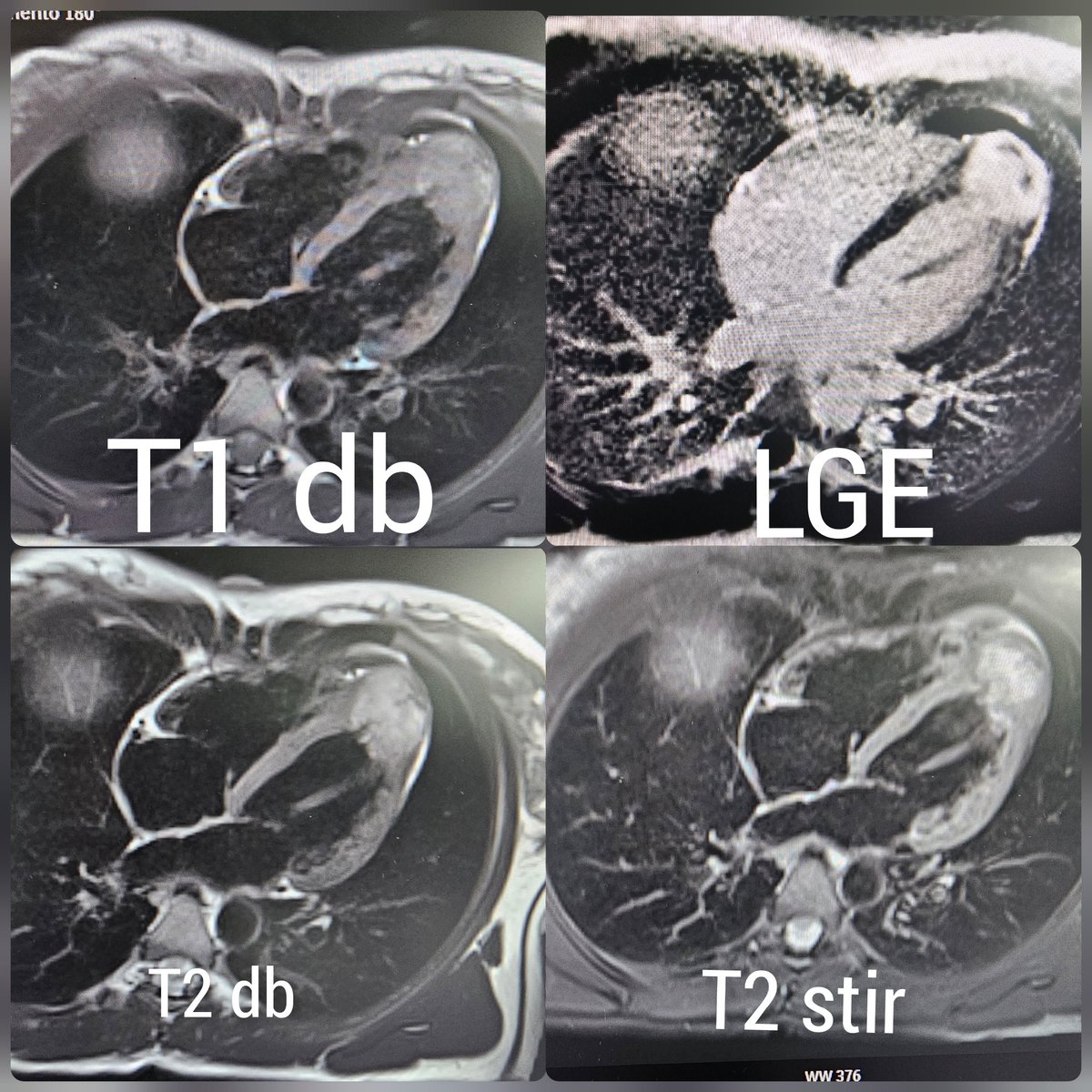 Anna Giulia Pavon (@annagiuliapavon) on Twitter photo Cardiac mass are always a challenge!
27yo F with apical cardiac mass, stabile in years
Benign nature according to Bologna CMR mass score: pubmed.ncbi.nlm.nih.gov/38502734/
#whyCMR
Any clues on what it is?
<a href="/AKallifatidis/">Alexandros Kallifatidis</a> <a href="/Doc_Tiger/">Manish Motwani</a> <a href="/AnnaBaritussio/">Anna Baritussio</a> <a href="/L_Bergamaschi/">Luca Bergamaschi</a> <a href="/P_Paolisso/">Pasquale Paolisso</a> <a href="/chiarabd/">C Bucciarelli-Ducci</a> Cardiac mass are always a challenge!
27yo F with apical cardiac mass, stabile in years
Benign nature according to Bologna CMR mass score: pubmed.ncbi.nlm.nih.gov/38502734/
#whyCMR
Any clues on what it is?
<a href="/AKallifatidis/">Alexandros Kallifatidis</a> <a href="/Doc_Tiger/">Manish Motwani</a> <a href="/AnnaBaritussio/">Anna Baritussio</a> <a href="/L_Bergamaschi/">Luca Bergamaschi</a> <a href="/P_Paolisso/">Pasquale Paolisso</a> <a href="/chiarabd/">C Bucciarelli-Ducci</a>