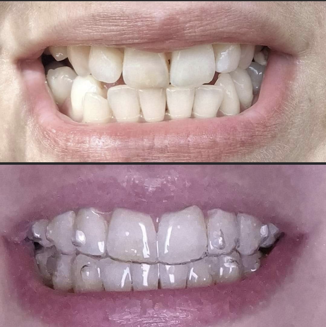 Sarah Tamsin // Web Dev & WordPress Specialist ✨ (@tamsininnit) on Twitter photo What 12 months of Invisalign looks like. If you are a fan of weird and slightly scary sensations, I recommend using removable plastic to shift your teeth around in your skull 🦷😁 10/10 <a href="/Invisalign/">Invisalign</a> What 12 months of Invisalign looks like. If you are a fan of weird and slightly scary sensations, I recommend using removable plastic to shift your teeth around in your skull 🦷😁 10/10 <a href="/Invisalign/">Invisalign</a>