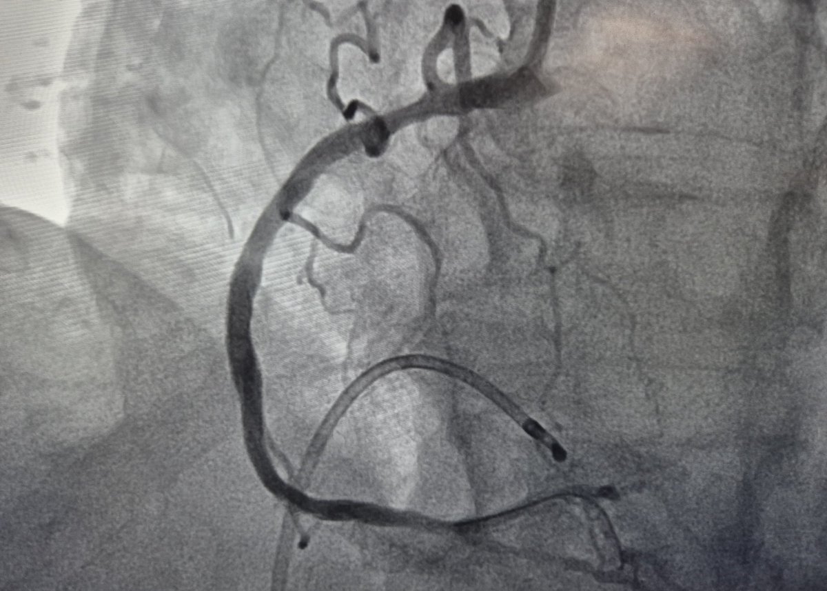 AsherElad's tweet photo. 94 y.o male with UAP, tight calcified lesion, no 🎈crossing. Use CSI, stent and post dil to 4 mm. With @dannydvir 

@PCRonline @Sbrugaletta @Ortega_Paz @Anazmicalik @guilbom @hect2701 @NicolaRyanI1 @DrPascalMeier @W_jyg @ICigalini @Hragy @SABOURETCardio
@mmamas1973 @djc795 @GreggWStone @toreyj01 @EAPCIPresident @CMichaelGibson @SmithElliotjs @ArielRoguin