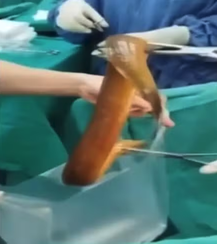 poptime's tweet photo. 🚨 MEU DEUS! Médicos removeram uma enguia VIVA de 60cm do abdômen de um paciente no Vietnã.

O animal começou a MASTIGAR os intestinos do homem de 31 anos após ele inseri-lo pelo ân*s para prazer s3xual. https://t.co/3kelBJVV8B