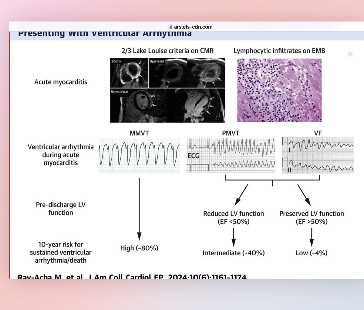 Ivan Mendoza (@mencardio) on Twitter photo Predictors for Recurrence of Ventricular Arrhythmia Presenting During Acute Myocarditis <a href="/ivanovich13/">Ivan Mendoza</a> <a href="/torresviera/">José Miguel Torres Viera</a> <a href="/SIAC_cardio/">SIAC</a> <a href="/CardiologiaSVC/">Sociedad Venezolana de Cardiología</a> <a href="/kargoncar13/">Dr. Karina Gonzalez Carta,MD,MS, FSSC, FACC, FSIAC</a> <a href="/HeliodoroRodri5/">Heliodoro Rodriguez</a> <a href="/gonzaeperez/">Gonzalo Perez</a> <a href="/Mdelsueldo/">Mildren del Sueldo</a> <a href="/Lguevaramath/">Lempira Guevara Matheus</a> <a href="/igormorr/">Igor Morr</a> <a href="/Risantilopezcar/">Ricardo Lopez Santi</a> <a href="/InfectiousDz/">Infectious Diseases</a>
sciencedirect.com/science/articl… Predictors for Recurrence of Ventricular Arrhythmia Presenting During Acute Myocarditis <a href="/ivanovich13/">Ivan Mendoza</a> <a href="/torresviera/">José Miguel Torres Viera</a> <a href="/SIAC_cardio/">SIAC</a> <a href="/CardiologiaSVC/">Sociedad Venezolana de Cardiología</a> <a href="/kargoncar13/">Dr. Karina Gonzalez Carta,MD,MS, FSSC, FACC, FSIAC</a> <a href="/HeliodoroRodri5/">Heliodoro Rodriguez</a> <a href="/gonzaeperez/">Gonzalo Perez</a> <a href="/Mdelsueldo/">Mildren del Sueldo</a> <a href="/Lguevaramath/">Lempira Guevara Matheus</a> <a href="/igormorr/">Igor Morr</a> <a href="/Risantilopezcar/">Ricardo Lopez Santi</a> <a href="/InfectiousDz/">Infectious Diseases</a>
sciencedirect.com/science/articl…