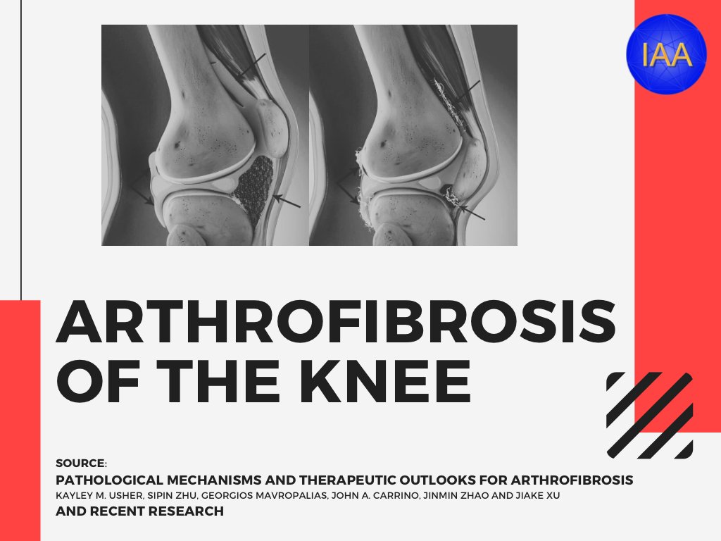 Arthrofibrosis of the knee - a series of infographics with huge thanks to Claudia Nedelcu and Beata Ambrus for the realization. A 🧵