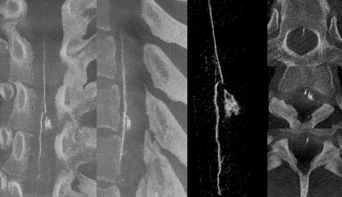eytanraz's tweet photo. Dissecting spinal radiculomedullary aneurysm as a cause of intracranial SAH. Full case on https://t.co/CukKjfjwn2  at https://t.co/f1ZUEauSnW https://t.co/bbHQgOWDJp