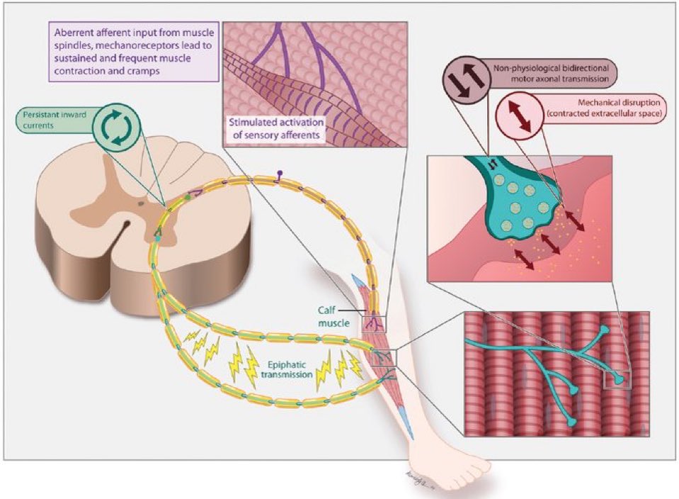 Muscle Cramp (MC)

MC👉a hyper-excitable neurologic phenomena of excessive, involuntary muscle contractions

Common causes👉Physiologic/Metabolic/ Medications/Neuromuscular Disorders/Neurologic Diseases

Pathophysiology underlying neurogenic MC👇

#muscle

practicalneurology.com/articles/2019-…