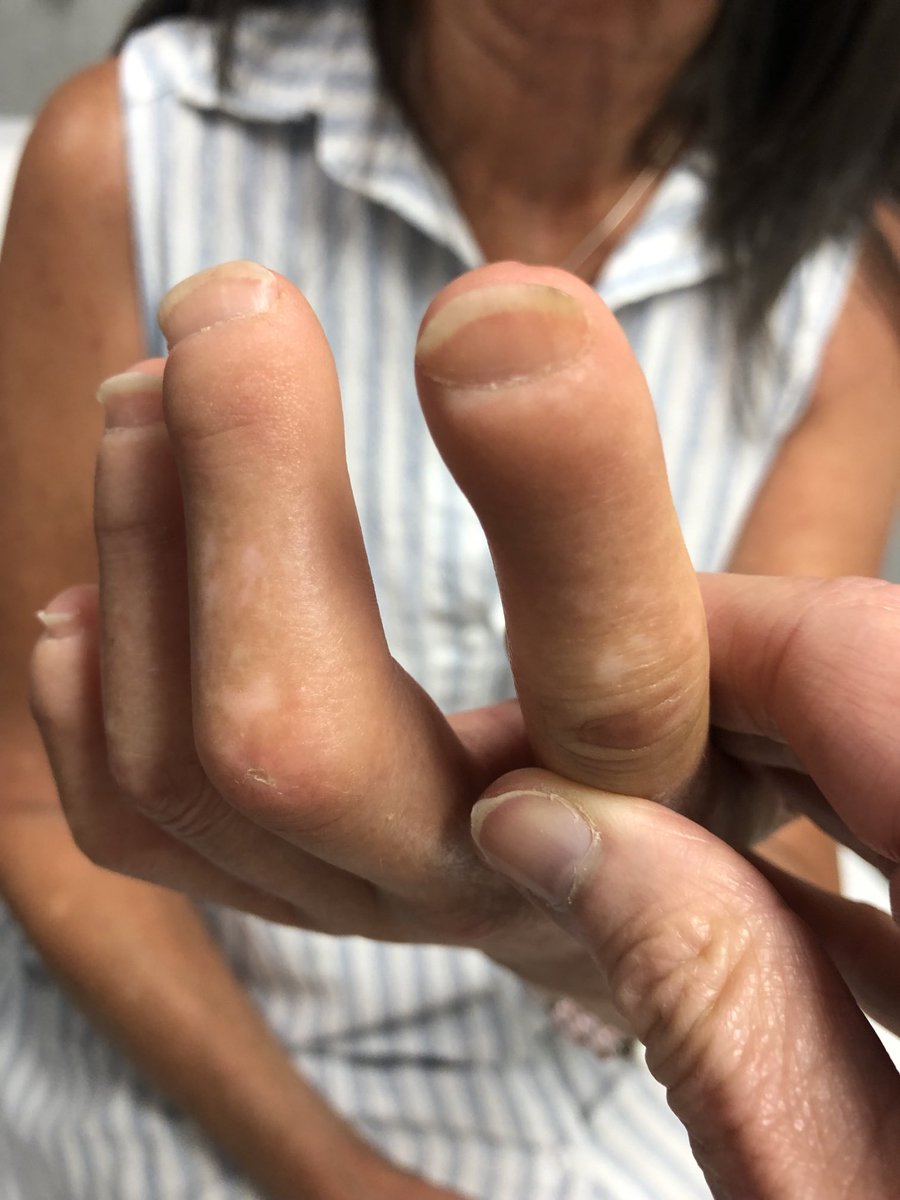 Janetbirdope's tweet photo. #ClinicalPearl
#Scleroderma #SSc
#Prayer’s sign
#sclerodactyly #digital #tuft #resorption
#digital #pits
#MedX #MedEd #RheumX #RheumEd https://t.co/5Vqg7QNwZn
