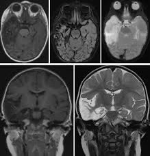 infeccHRUmalaga's tweet photo. Es posible #Encefalitis con #LCR SIN aumento d #celularidad 🧠🧪? SI‼️@CIDJournal:25% todas las encefalitis y 23.7% de #VHS1🧠🦠tuvieron AUSENCIA d pleocitosis➡️RETRASO en #aciclovir💉
OJO👀: No retrases Aciclovir si sospecha aunq células bien en LCR
🔗🆓👉🏻https://t.co/yi6J1ICmCN https://t.co/lTN3UIALnu