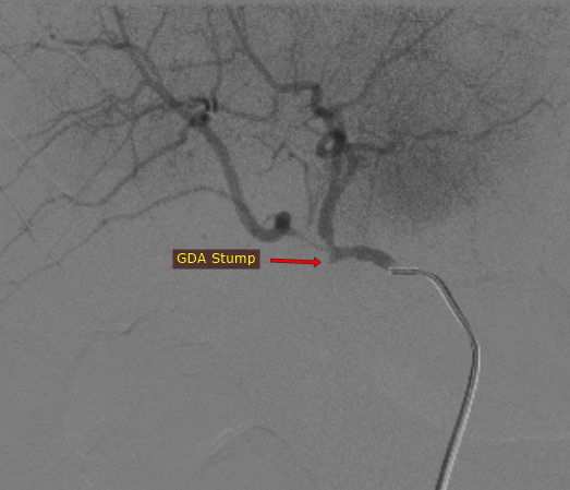 Interventional Radiology BIR, RGGGH@Chennai tweet media