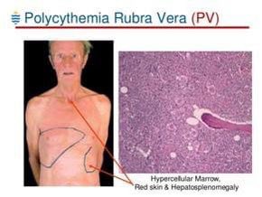 hemo_shk's tweet photo. #Polycythemia
Polycythemia refers to an increase in red cell count, hematocrit, and usually hemoglobin. True polycythemia may be either primary or secondary.
Primary true polycythemia:
•Uncontrolled production of red cells by the bone marrow.
Clinical features:
•Look for plethoric features of the patient.
•Look for peripheral arterial pulsations.
•Note for limb swelling (venous thrombosis) or digital ulcerations (arterial thrombosis).
•Look for itching marks due to pruritus.
•Check the blood pressure for hypertension.
•Look for a swollen erythematous big toe (gout).
•Examine the abdomen for splenomegaly.
Question: What are the causes of secondary polycythemia?
Answer: Increased renal erythropoietin production either due to hypoxia or renal causes, e.g., renal causes or ectopic tumors.
Investigations:
•High red cell count, hemoglobin, hematocrit, whole blood viscosity, and uric acid.
#MEDHM @IhabFathiSulima #MedEd
#MedX
