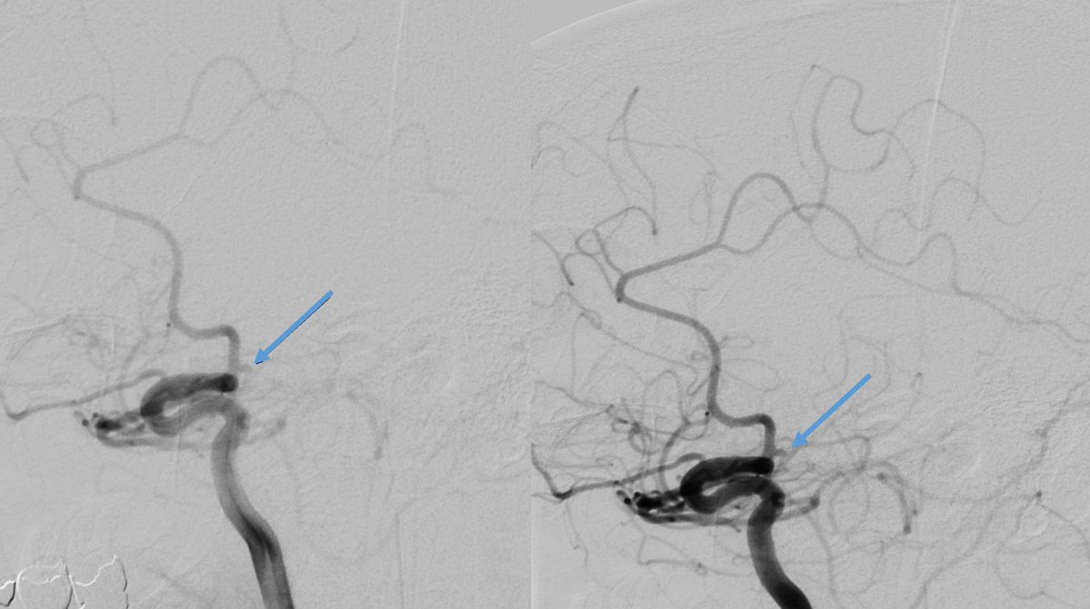 Great way to start the week, with an aneurysm quiz!

Female, 54 years old, asymptomatic. FH: mother died of ruptured cerebral aneurysm and daughter died of ruptured cerebral aneurysm, 3 months ago.
MRI for "aneurysmophobia" with suspicion of right A1 aneurysm.
DSA in our centre.