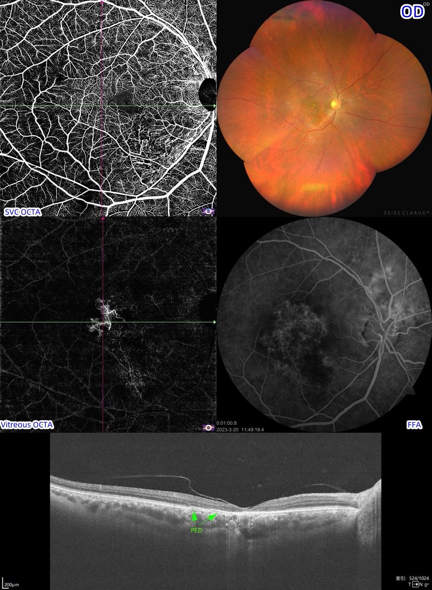 toward_pi's tweet image. FFA or UWF full-range #OCTA? 
A type 2 #diabetic patient who was diagnosed with AMD in both eyes and #BRVO (after PRP) in the left eye complained of more severe #visionloss recently. Ultra-wide-field (UWF) color fundus images revealed... 
See more➡️
linkedin.com/posts/towardpi…