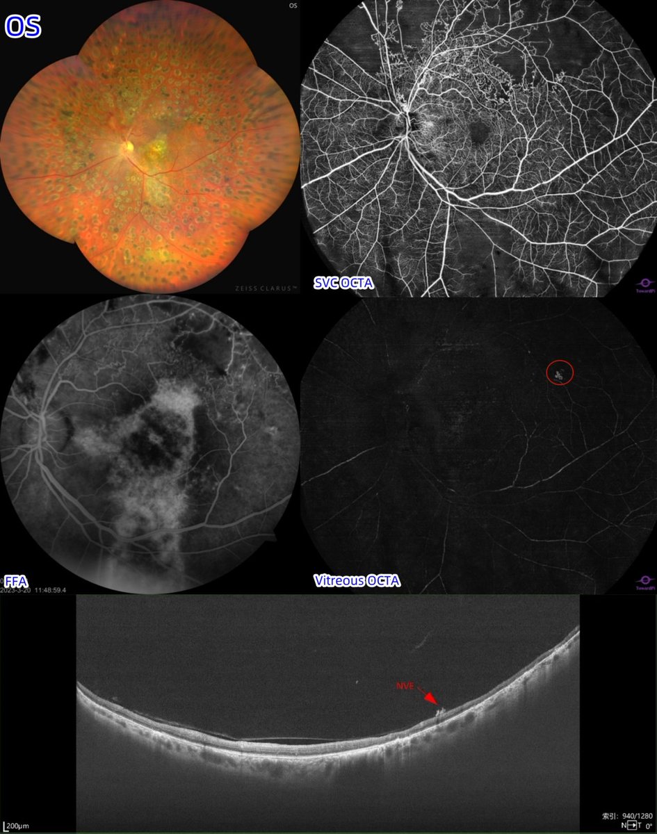toward_pi's tweet image. FFA or UWF full-range #OCTA? 
A type 2 #diabetic patient who was diagnosed with AMD in both eyes and #BRVO (after PRP) in the left eye complained of more severe #visionloss recently. Ultra-wide-field (UWF) color fundus images revealed... 
See more➡️
linkedin.com/posts/towardpi…