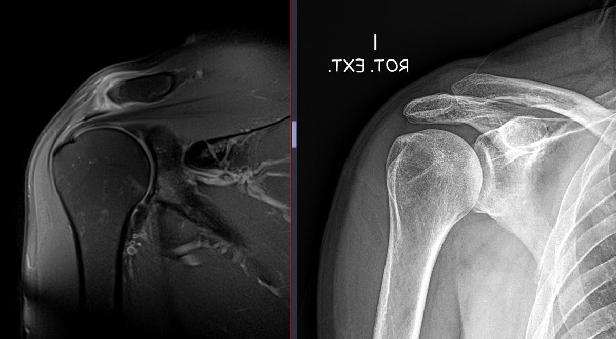 5/8/2024. 🟥 Rockwood grade I AC joint injury after thoracic trauma🎯. Male, 60 yo.

MRI Findings: AC sprain + normal coracoclavicular ligaments and no osseous step. 

XRAY findings: subtle increased dorsal periarticular soft tissue density. 

#MSK  #MRI #traumatwitter #shoulder