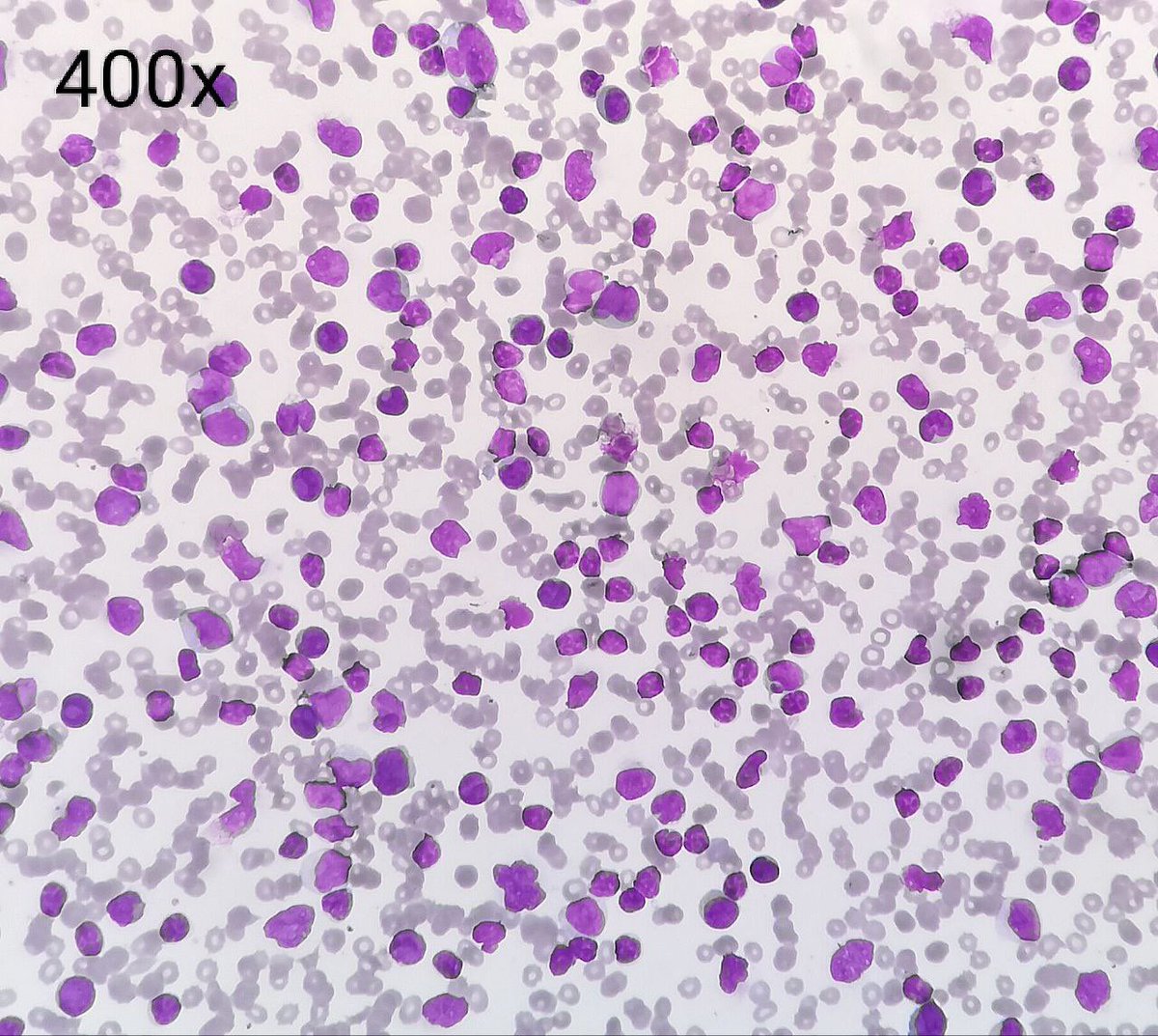 Thulas31081987's tweet image. When the bad and ugly stare at you together 😳
A case of concurrent Chronic Lymphocytic Leukemia and Acute Myeloid Leukemia 
#AML #CLL #Flowcytometry #FlowTCS2024
@ICCS_Education @drkunalsehgal @ananthvikas @DrArunCMC @LakshmiKoulmane @drdatari  @DrAnilHandoo @CytometryIndia