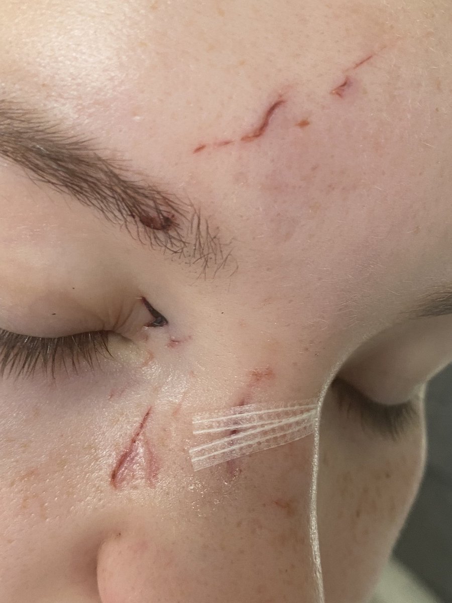 clbaileywriter's tweet photo. Despite my 19yo daughter providing a crime no, pics of her injuries, evidence of Victim Support &amp; counselling following a recent unprovoked serious assault, @oxfamfestivals are still refusing to return her ‘refundable’ Boomtown deposit without further evidence. Disappointing. https://t.co/joakmQOMwG