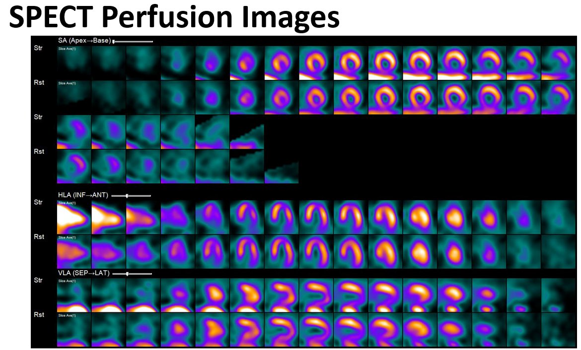 MyASNC's tweet image. New #CVNuc #ThinkPET case poll! 78-year-old woman with hypertension, dyslipidemia &amp;amp; TIA undergoes SPECT and subsequent F-18 flurpiridaz PET for evaluation of dyspnea. What best describes the SPECT and PET image findings? Vote below. 
@JNCjournal @PETpartnership @CardioNerds