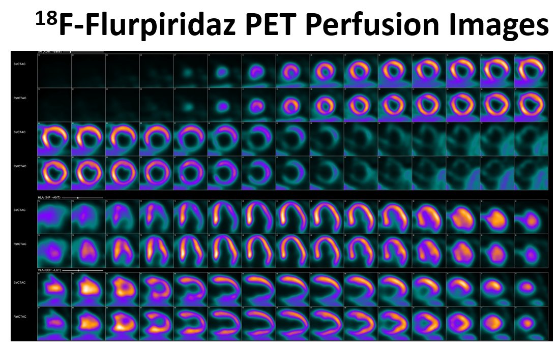 ASNC Society (@myasnc) on Twitter photo New #CVNuc #ThinkPET case poll! 78-year-old woman with hypertension, dyslipidemia & TIA undergoes SPECT and subsequent F-18 flurpiridaz PET for evaluation of dyspnea. What best describes the SPECT and PET image findings? Vote below.
<a href="/JNCjournal/">Journal of Nuclear Cardiology</a> <a href="/PETpartnership/">PETpartnershipUK</a> <a href="/CardioNerds/">CardioNerds</a> New #CVNuc #ThinkPET case poll! 78-year-old woman with hypertension, dyslipidemia & TIA undergoes SPECT and subsequent F-18 flurpiridaz PET for evaluation of dyspnea. What best describes the SPECT and PET image findings? Vote below.
<a href="/JNCjournal/">Journal of Nuclear Cardiology</a> <a href="/PETpartnership/">PETpartnershipUK</a> <a href="/CardioNerds/">CardioNerds</a>