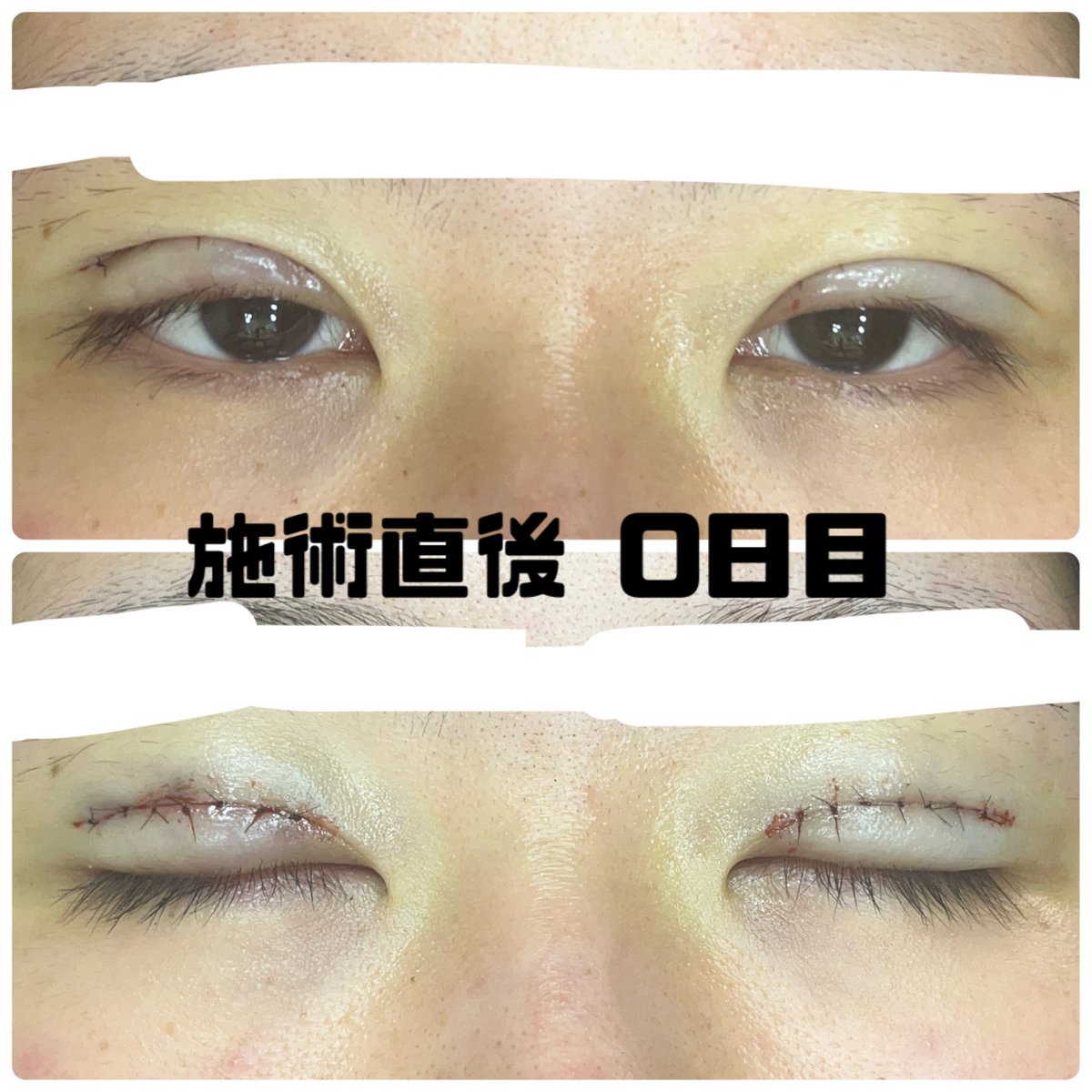 vn_uxx's tweet photo. 二重切開　DT   

⚠️閲覧注意
施術直後　0日目

麻酔が切れてから痛みが酷い。目が開けられず、下の方しか見れない。血もちょこちょこ出てきた。

#二重整形　#二重切開　#整形　#切開　#二重切開dt https://t.co/OwRZdQtXCK