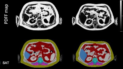 Assessing sex-specific abdominal fat volume &amp; proton density fat fraction using automated MRI segmentation doi.org/10.1148/ryai.2… <a href="/MingmingWu10/">Mingming Wu</a> <a href="/BMRRgroup/">BMRR</a> #MRI #AI #ML