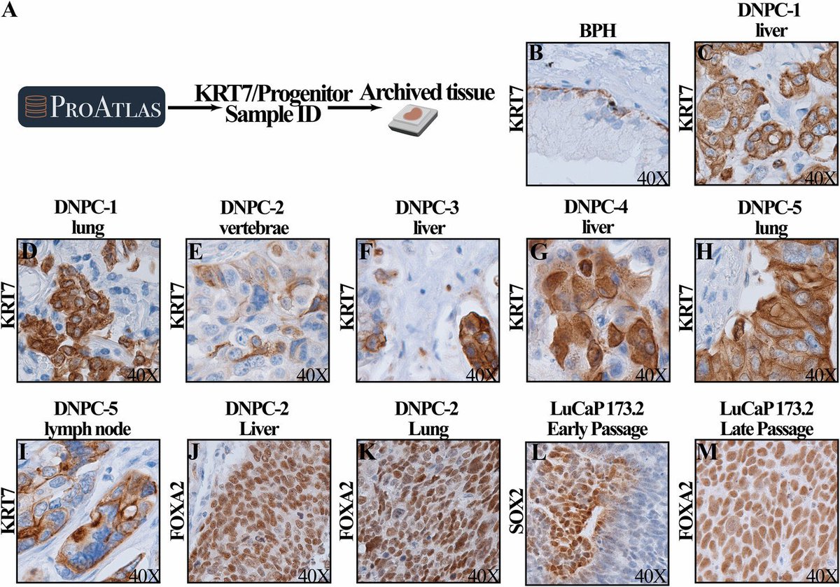 Siyuan Cheng, PhD (@chengsiyuan1004) on Twitter photo In this paper, using scRNAseq➡️ bulk RNAseq ➡️ IHC, we identified and validated two novel AR-/NE- prostate cancer subtypes: KRT7 & progenitor-like. Patients with these markers are less responsive to ADT🧐. #prostatecancer #Bioinformatics <a href="/ProstateCell/">Prostate Cell News</a> <a href="/LSUHSResearch/">LSU Health Shreveport Research</a> <a href="/LSUHS_PhD/">LSUHS School of Graduate Studies</a> In this paper, using scRNAseq➡️ bulk RNAseq ➡️ IHC, we identified and validated two novel AR-/NE- prostate cancer subtypes: KRT7 & progenitor-like. Patients with these markers are less responsive to ADT🧐. #prostatecancer #Bioinformatics <a href="/ProstateCell/">Prostate Cell News</a> <a href="/LSUHSResearch/">LSU Health Shreveport Research</a> <a href="/LSUHS_PhD/">LSUHS School of Graduate Studies</a>